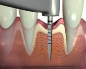 Ugradnja implantata - 1