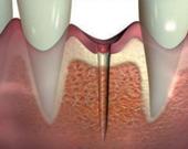 Ugradnja implantata - 2