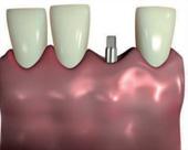 Ugradnja implantata - 4